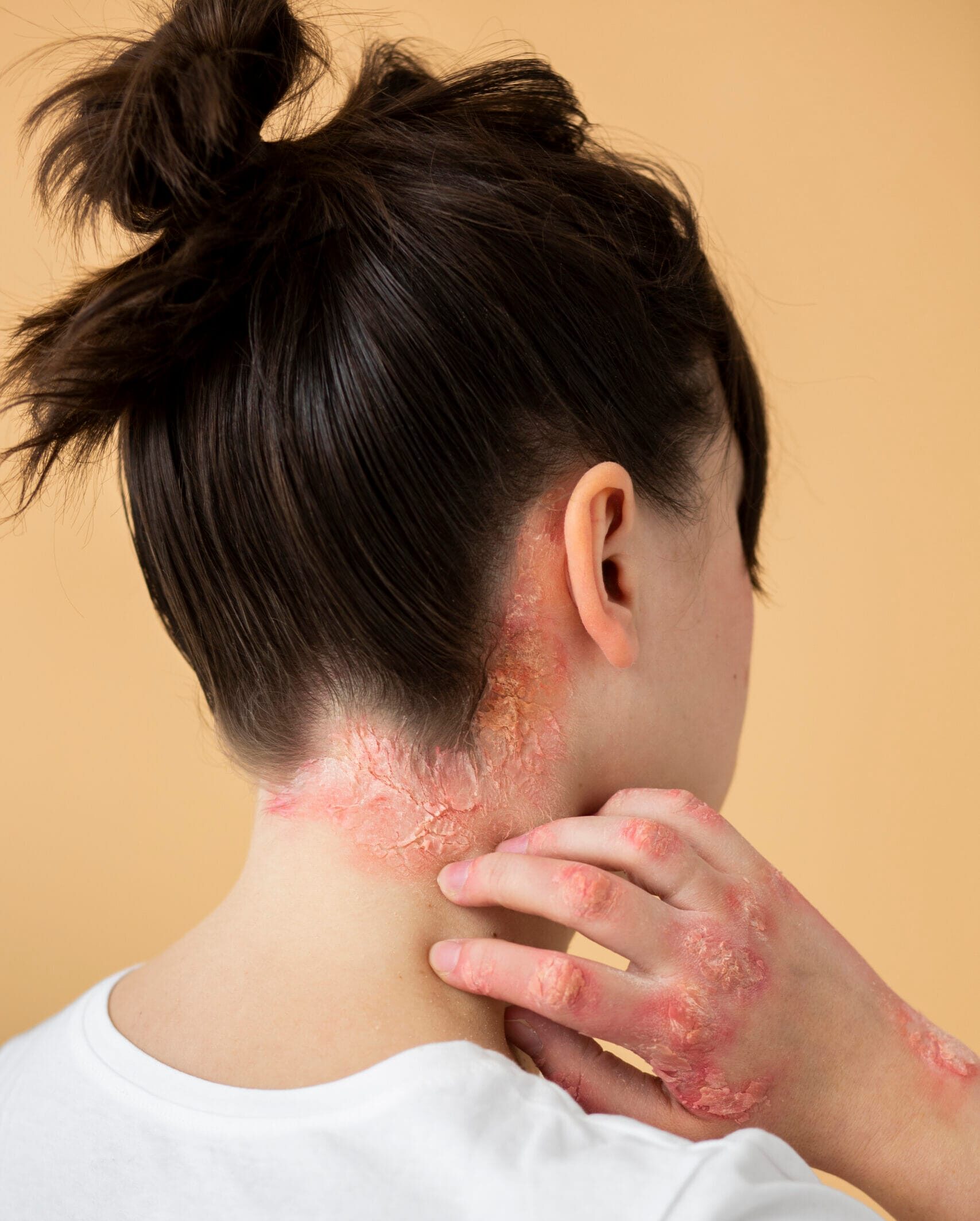 Psoriasis and eczema on neck treated at best dermatology hospital in Gurgaon offering skin allergy and hair loss treatment